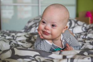 baby with down syndrome