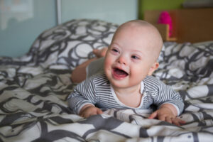 baby with down syndrome